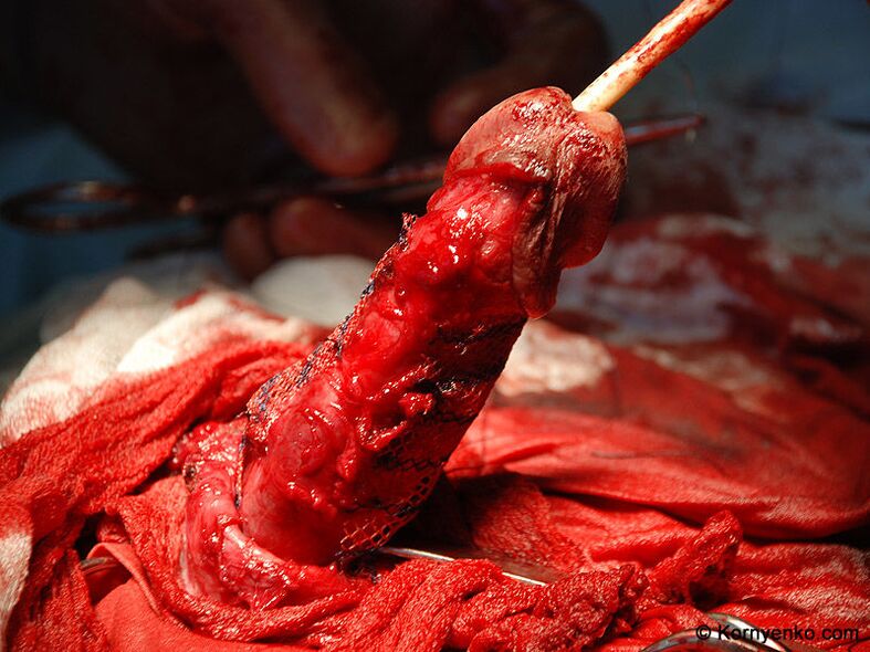 kollagén mátrix telepítése a pénisz megnagyobbítására