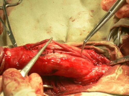 péniszbővítő műtét elvégzése