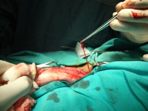 pénisznövelő műtét