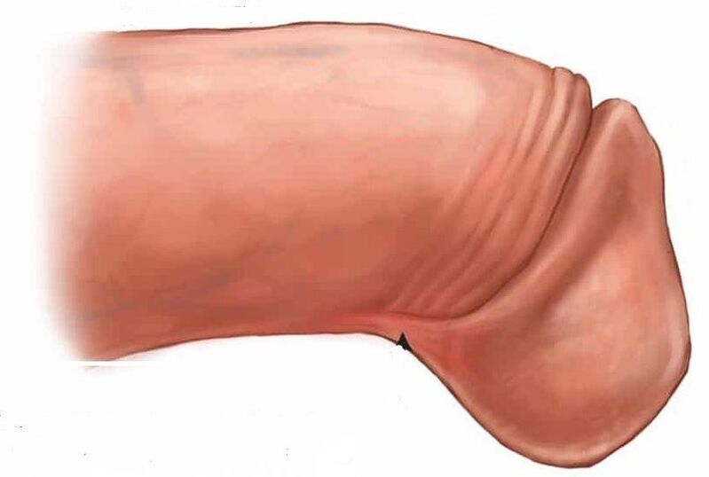 hogyan lehet megnövelni a pénisz makkját